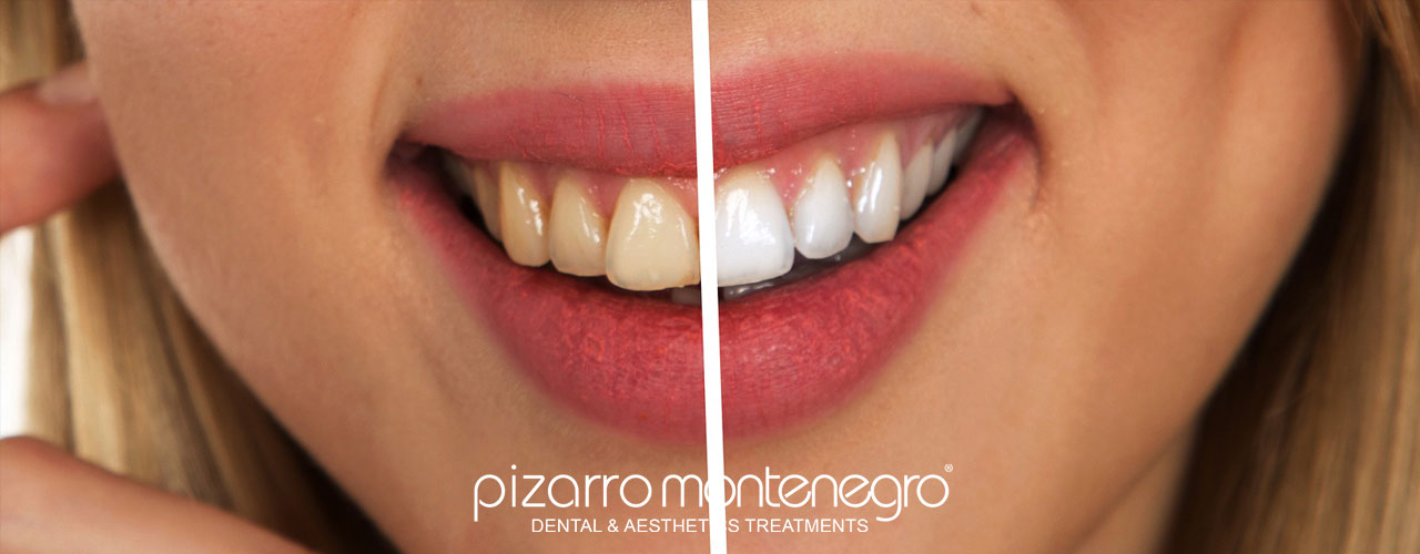 Pain-free technology: discover dental cleaning with AirFlow and Perioflow