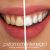 Pain-free technology: discover dental cleaning with AirFlow and Perioflow